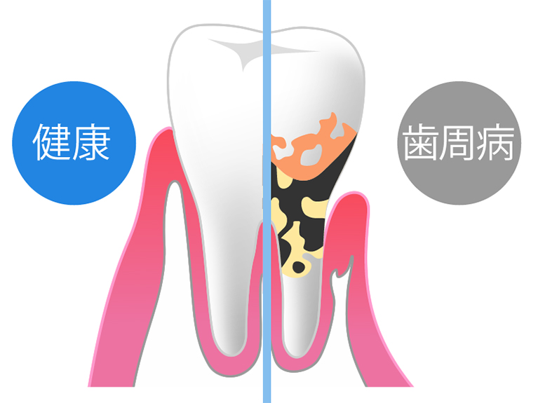 歯周病とは